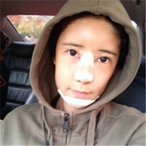 分享面部自體脂肪填充前后的照片，還有恢復(fù)過程，果很好哦~