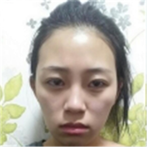 自體脂肪面部填充一年了，分享我的恢復(fù)過程，有前后對(duì)比照片哦~