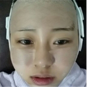 自體脂肪面部填充一年了，分享我的恢復(fù)過程，有前后對(duì)比照片哦~