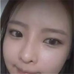 做了磨顴骨和面部脂肪填充，分享前后對(duì)比果圖片哦~