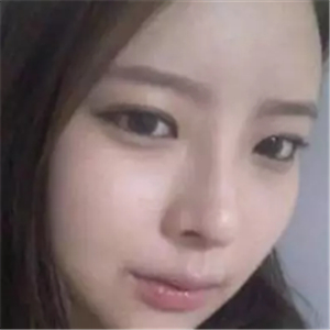 做了磨顴骨和面部脂肪填充，分享前后對(duì)比果圖片哦~