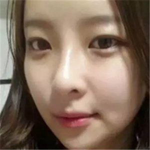 做了磨顴骨和面部脂肪填充，分享前后對(duì)比果圖片哦~