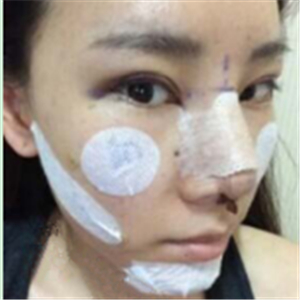 自體脂肪面部填充半年了， 皮膚好了，分享恢復(fù)照片哦~~