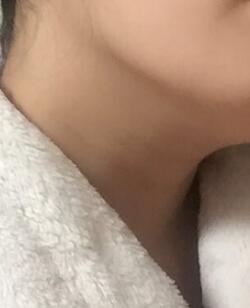 電波l皮除皺是刺激膠原蛋白的增生