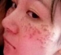 激光去雀斑價(jià)格3800元，術(shù)后恢復(fù)過程和術(shù)后注意事項(xiàng)分享