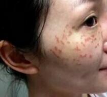 激光去雀斑價(jià)格3800元，術(shù)后恢復(fù)過程和術(shù)后注意事項(xiàng)分享