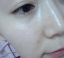 激光去雀斑價(jià)格3800元，術(shù)后恢復(fù)過程和術(shù)后注意事項(xiàng)分享