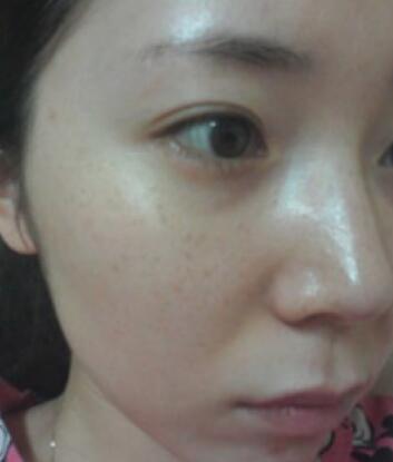 激光去雀斑手術(shù)前的照片