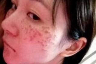 激光去雀斑手術(shù)后的照片