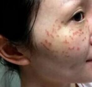 激光去雀斑第二天