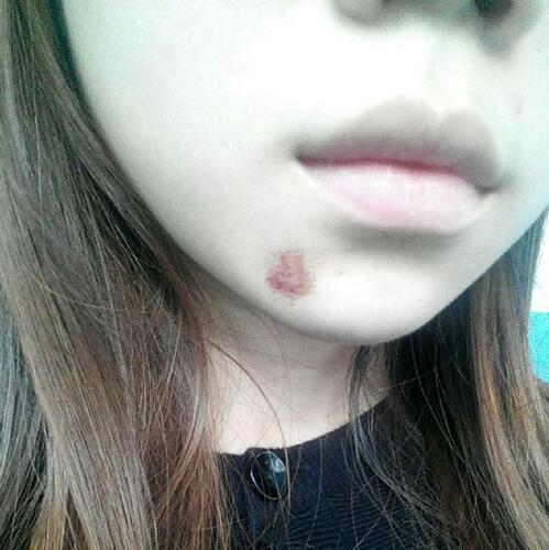 在廈門*菲做的激光祛疤過程分享