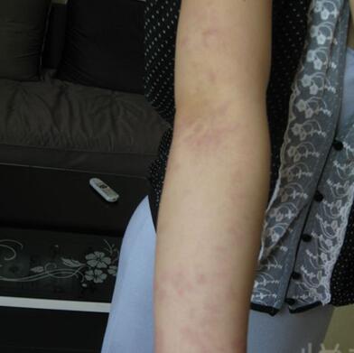 激光祛紅色胎記和跟隨了我20多年的胎記終于說拜拜了