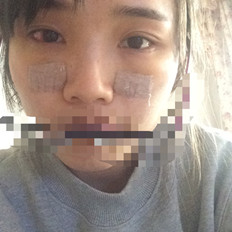 自體脂肪填充淚溝手術(shù)前后對(duì)比照片和恢復(fù)過程分享