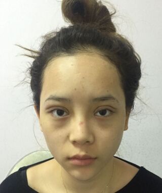 尹度龍醫(yī)生做的雙眼皮無比的自然美麗