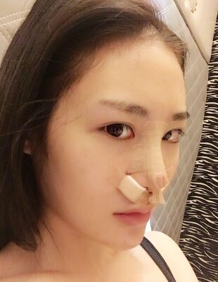 在隆鼻整形之后終于有了超精致的鼻子，尹度龍做的喲
