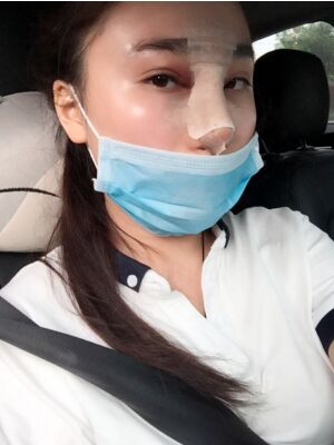 膨體隆鼻改變了我的塌鼻子，整體都精致不少