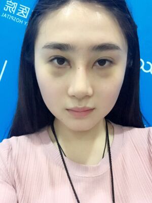 膨體隆鼻改變了我的塌鼻子，整體都精致不少