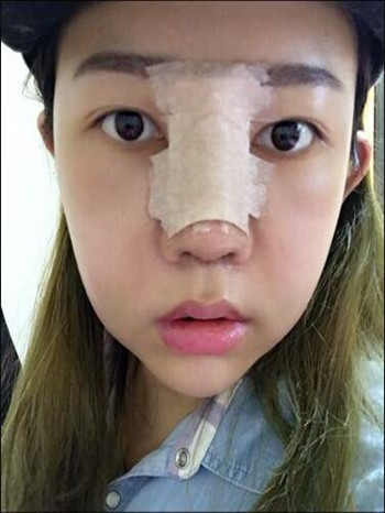 做了隆鼻整形手術(shù)果真的很不錯(cuò) 大家快來(lái)看看吧