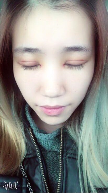 做了全切雙眼皮 整個(gè)眼睛都變大了氣質(zhì)也不一樣了