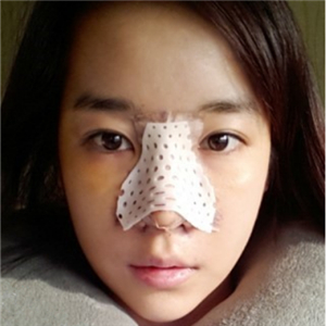 廣州博仕做了隆鼻整形半年了，分享恢復(fù)過程和前后對比果照片哦~