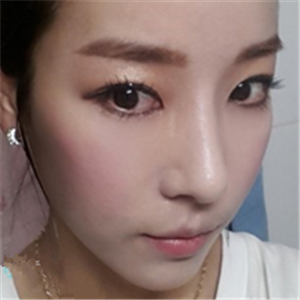 廣州博仕做了隆鼻整形半年了，分享恢復(fù)過程和前后對比果照片哦~