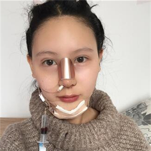 隆鼻整形手術(shù)恢復(fù)過(guò)程照片分享，廣州博仕做的哈~~