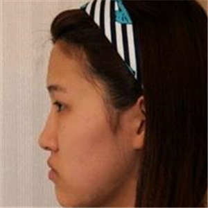 去年做了隆鼻整形，分享恢復(fù)過(guò)程和前后對(duì)比果圖片哦，