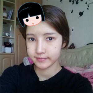 去年做了隆鼻整形，分享恢復(fù)過(guò)程和前后對(duì)比果圖片哦，