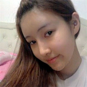 去年做了隆鼻整形，分享恢復(fù)過(guò)程和前后對(duì)比果圖片哦，