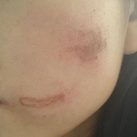 兩次激光祛疤過程圖片分享給大家做割參考