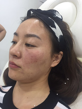 蛋白線面部埋埋蛋白線.提升，改良我的皮膚問題