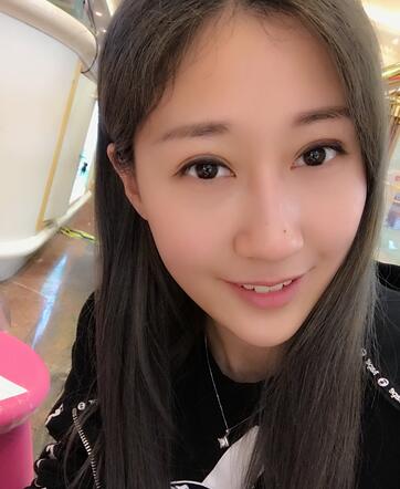 埋線雙眼皮七天恢復(fù)圖