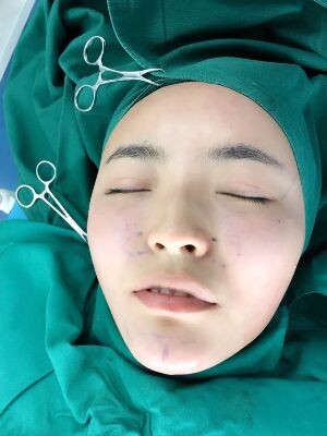 自體脂肪全臉填充之后臉變小了也更精致了