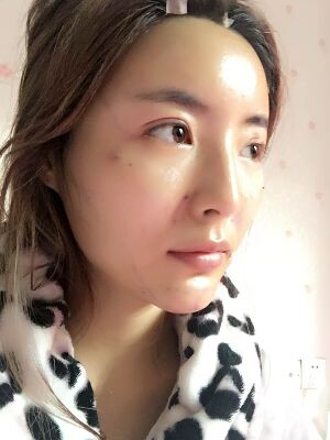 自體脂肪全臉填充之后臉變小了也更精致了