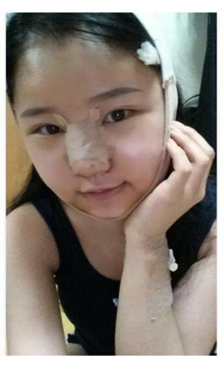 做了下頜角整形手術 大臉貓變成巴掌臉果還不錯哦