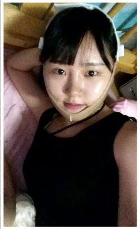 做了下頜角整形手術 大臉貓變成巴掌臉果還不錯哦