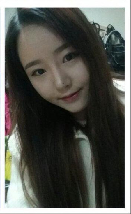 做了下頜角整形手術 大臉貓變成巴掌臉果還不錯哦