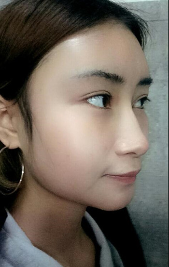 馮斌做的自體脂肪全臉填充大家?guī)臀铱纯垂趺礃? /> </a>
										<a href=