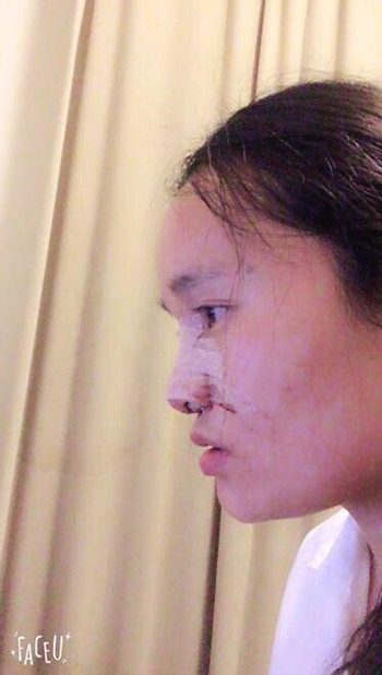 做了隆鼻整形手術整個鼻子靈巧了許多 快來圍觀果