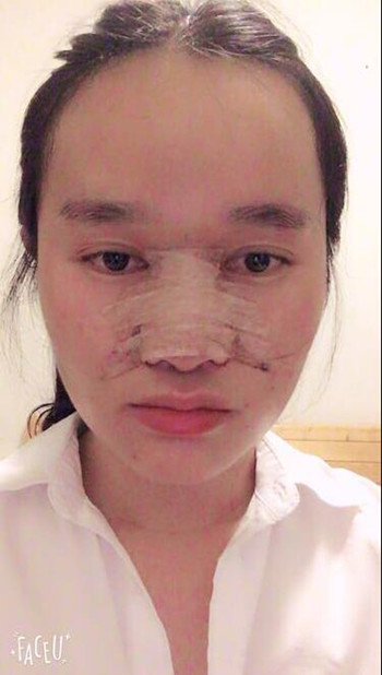 做了隆鼻整形手術整個鼻子靈巧了許多 快來圍觀果