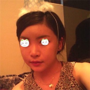 分享美立方做下頜角整形手術(shù)經(jīng)歷，還有前后對比果圖片哦~