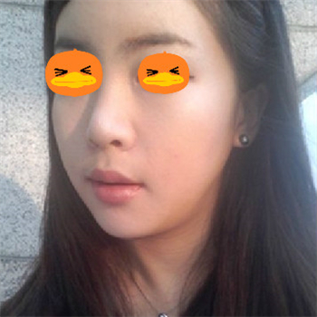 分享美立方做下頜角整形手術(shù)經(jīng)歷，還有前后對比果圖片哦~