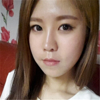 藝星做的玻尿酸去法令紋，分享恢復(fù)過(guò)程和前后對(duì)比照片~