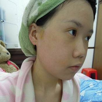 磨下頜角面部輪廓整形上個月，分享恢復(fù)過程和對比照片哦~