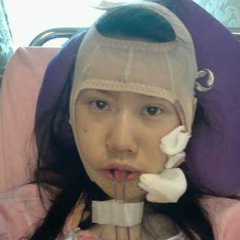 磨下頜角面部輪廓整形上個月，分享恢復(fù)過程和對比照片哦~