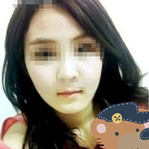 南相宰磨下頜角手術(shù)恢復(fù)過程分享，還有前后對比圖片哦~