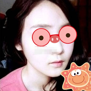 南相宰磨下頜角手術(shù)恢復(fù)過程分享，還有前后對比圖片哦~