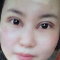 割雙眼皮和開內(nèi)眼角一起做了，護理了近一個月完全恢復(fù)自然