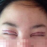 割雙眼皮和開內(nèi)眼角一起做了，護理了近一個月完全恢復(fù)自然