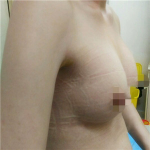 假體隆胸讓我找回了做女人的自信